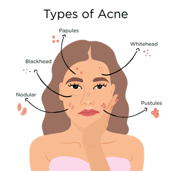 Acne & Scars – Shri Hari Skin Care